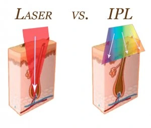 طول موج لیزر IPL